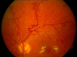 Obr. č. 1Diabetická retinopatie diabeticka-retinopatie